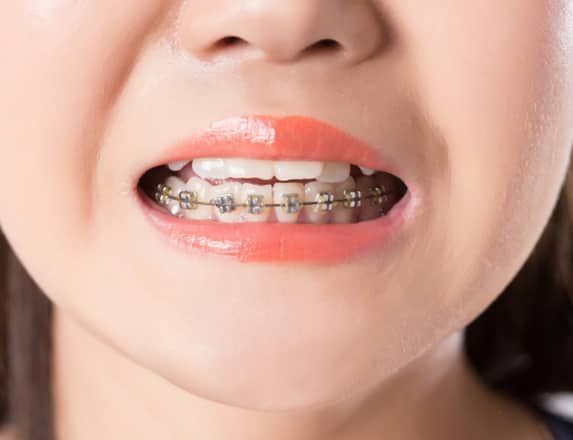 what are braces for children min