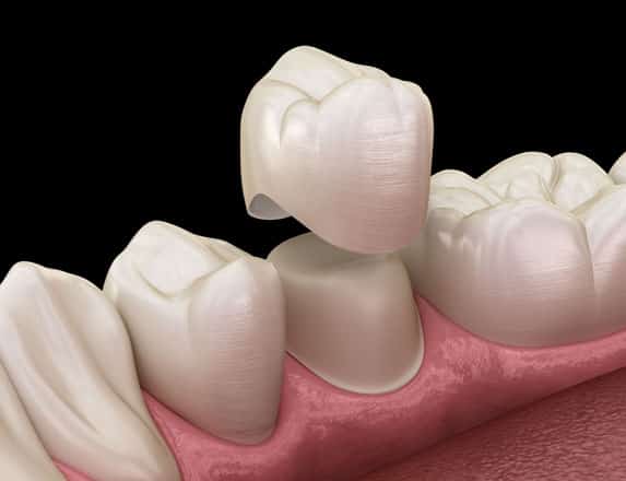 what are porcelain crowns min